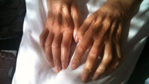 Incapacidad Permanente Parcial 9 incapacidad ELA